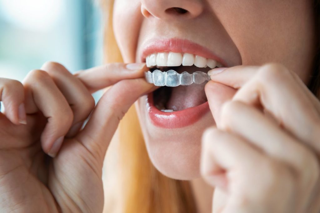 Benefits of Choosing an Orthodontist over Mail-Order Aligners